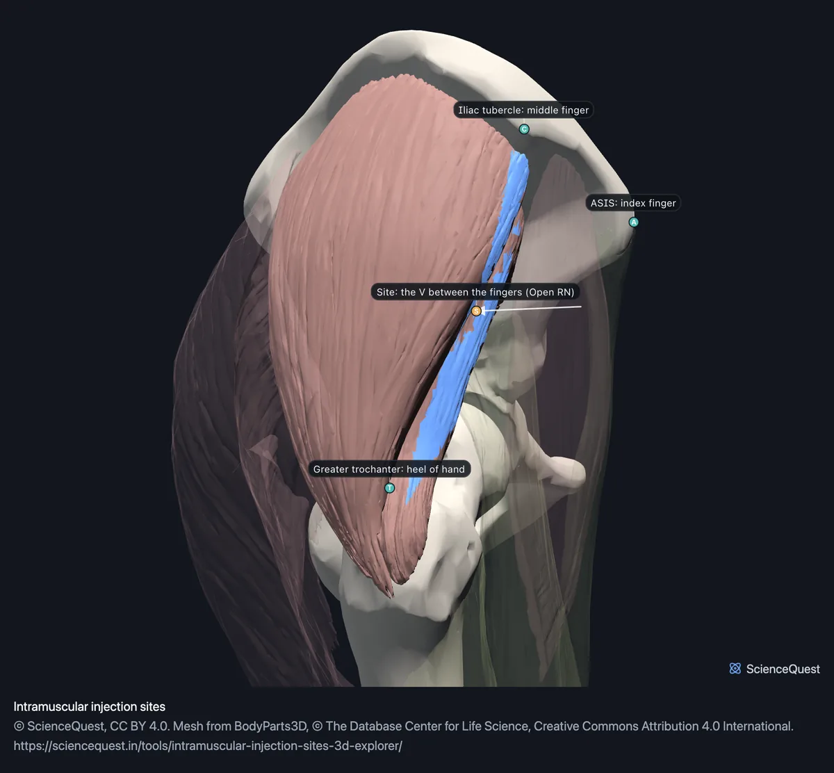 The right hip from the side, the ventrogluteal zone painted blue on the gluteus medius, with pins at the iliac tubercle, the anterior superior iliac spine and the greater trochanter.